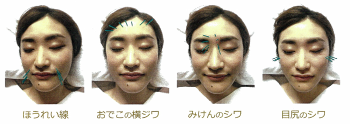 岩国市にある高松鍼灸院 立体造顔美容鍼の技術を採用した 美顔鍼 を提供